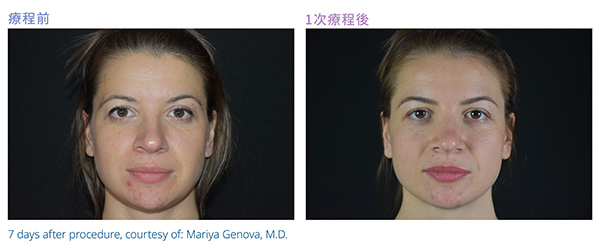 泛紅暗啞：療程前與 1 次療程後對比（療程後 7 天，Mariya Genova, M.D. 提供）