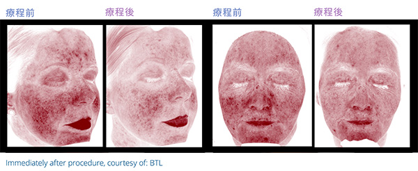 泛紅敏感紅區分析圖：療程前與 1 次療程後對比（療程後即時，BTL 提供）
