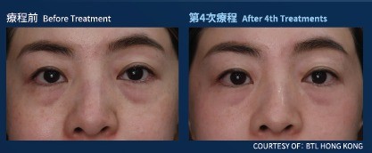 眼部：療程前與第 4 次療程後對比（個案一）