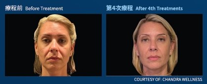 面部輪廓：療程前與第 4 次療程後對比（個案二）