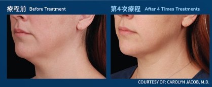 下巴：療程前與第 4 次療程後對比（個案二）