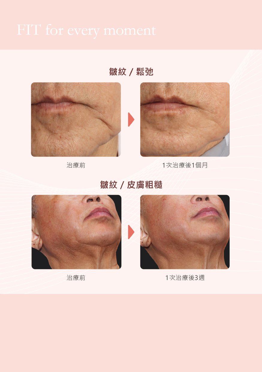 XERF 治療實證：皺紋／鬆弛（1次治療後1個月）；皺紋／皮膚粗糙（1次治療後3週）