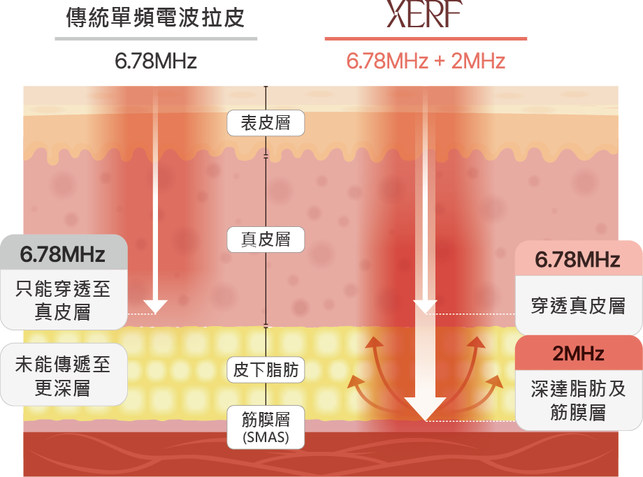 傳統單頻電波拉皮 6.78MHz 只能穿透至真皮層；XERF 6.78MHz + 2MHz 穿透真皮層並深達脂肪及筋膜層（SMAS）。皮膚層次：表皮層、真皮層、皮下脂肪、筋膜層